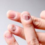 Gljivične infekcije noktiju-onychomycosis
