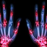 Oblici artritisa